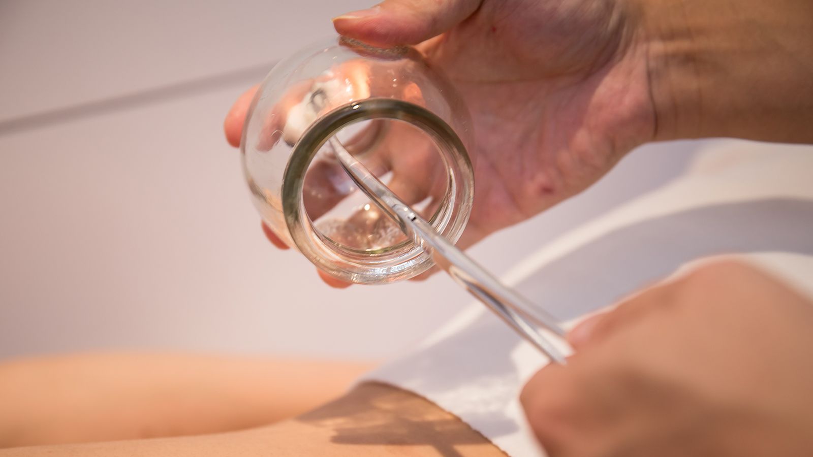TCM practitioner performing cupping therapy with a glass cup